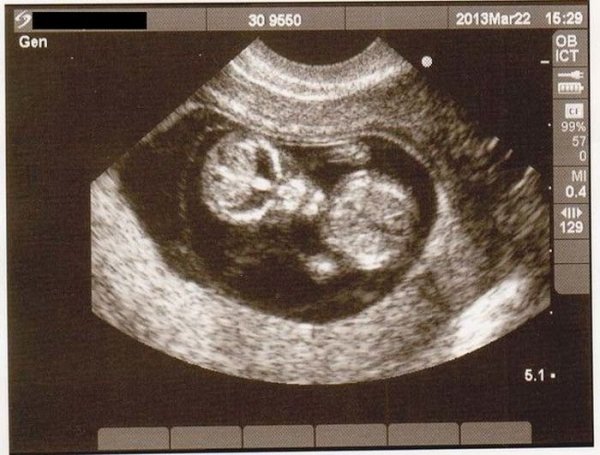Как выглядят дети в утробе матери на экранах аппаратов УЗИ