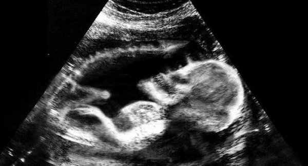 Как выглядят дети в утробе матери на экранах аппаратов УЗИ