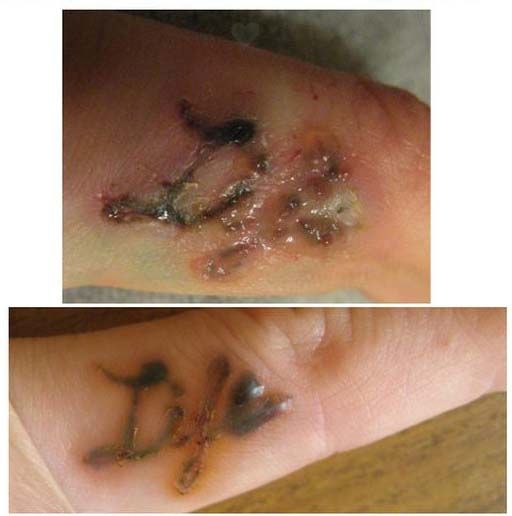 К чему приводит самостоятельное удаление татуировок
