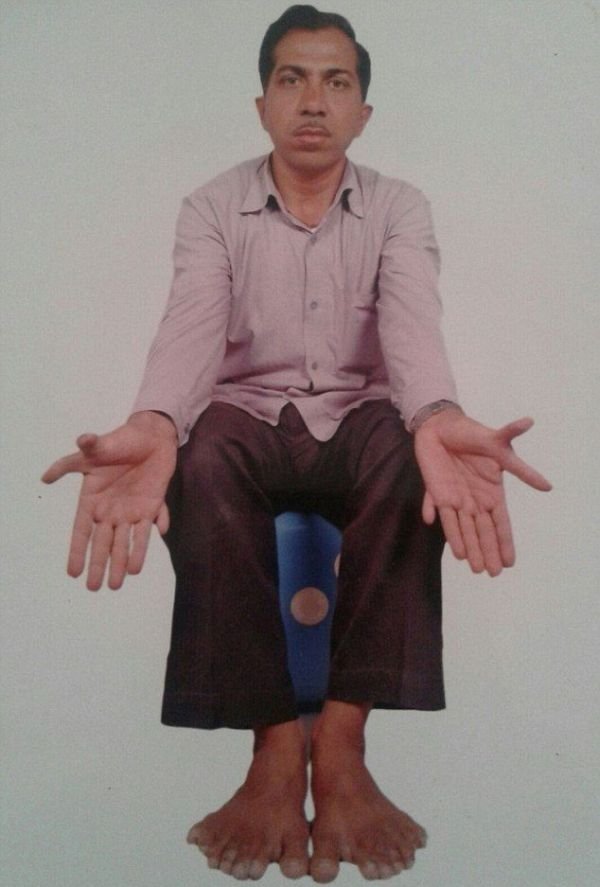 Девендра Сутхар - рекордсмен мира по количеству пальцев на руках и ногах