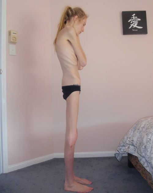 Больная анорексией девушка набрала 40 кг за 7 месяцев