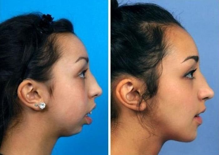  Невероятное преображение девушки с недоразвитой нижней челюстью